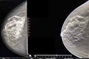 A breast mammogram