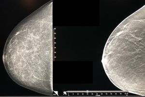 A breast mammogram