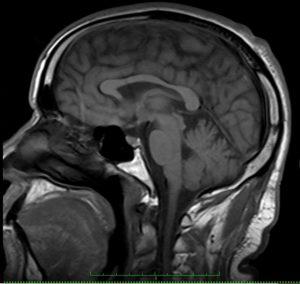 An MRI of the brain.