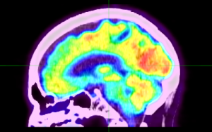 PET/CT scan of the brain