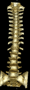 A scan showing the bones of the spine and pelvic area.