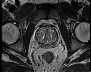 An MRI of a part of the spine.