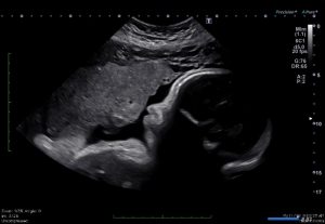 An ultrasound of a fetus.