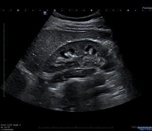 An ultrasound of the thyroid gland.